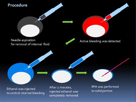 The Role Of Ethanol Ablation During Radiofrequency Ablation Of Thyroid