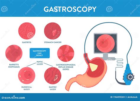 Gastroscopy Procedure. Human Stomach With Peptic Ulcer, And Endoscopic ...