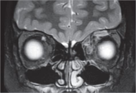 Conjunctival Papillomatous Lesion Pediatric Cancer Jama Ophthalmology Jama Network