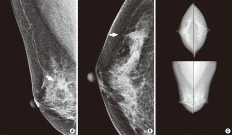 A 61 Year Old Asymptomatic Woman Underwent Screening Mammography A Download Scientific