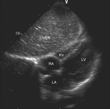 Echocardiography | Radiology Key