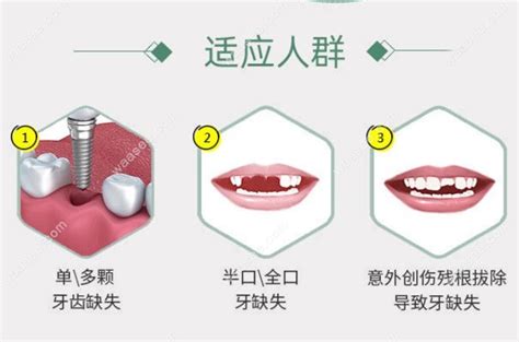 呼市华医口腔医院种植牙收费 现搞活动种植一颗牙价格3680 口腔资讯 牙齿矫正网