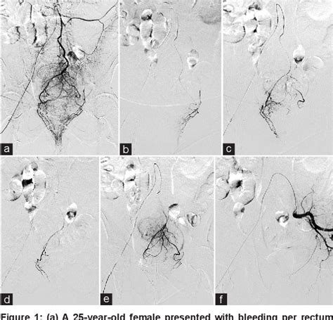 Table 1 From New Technique Of Embolization Of The Hemorrhoidal Arteries