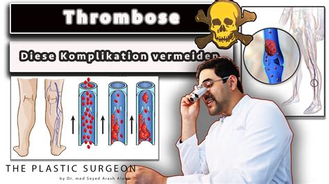 Thrombose und Lungenembolie erkennen als GEFÄHRLICHE Komplikation