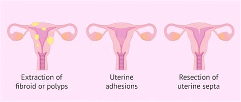 When to use hysteroscopy