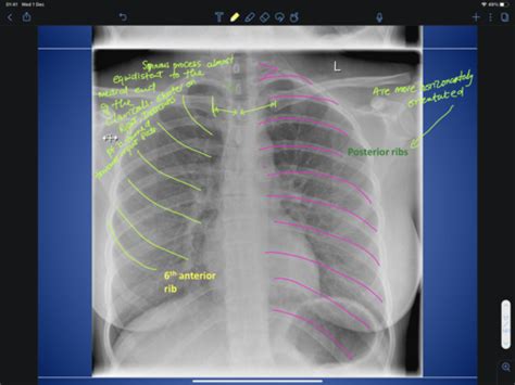 Chest X Ray Flashcards Quizlet