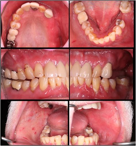 Increased Frequency Of Oral Plasma Cell Mucositisplasma Cell