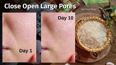 Close Open Large Pores In Just 7 Days 😍 Most Effective Home Remedy 👌🏻