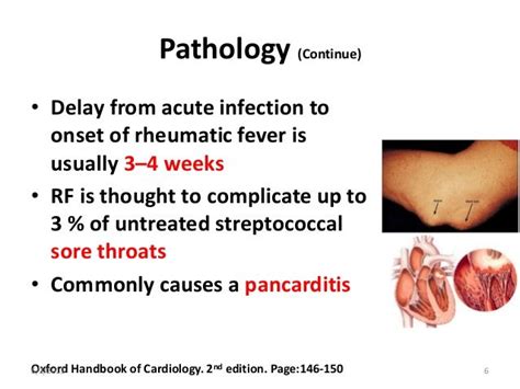 Rheumatic Fever