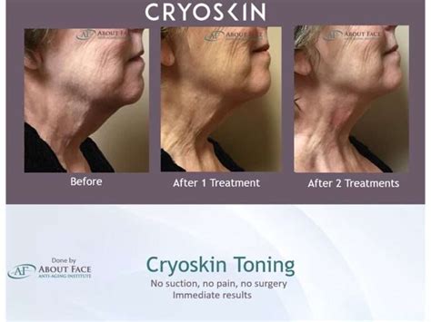 Cryoskin Facial How It Works And What Are Its Benefits