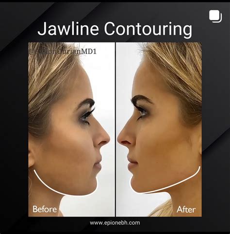 Thread lift for double chin reduction: Is It the solution you have been ...