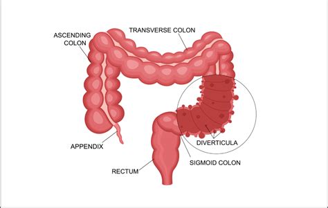 Diverticulitis Vector Illustration Labeled Medical Diagram Off