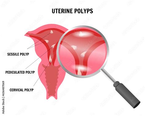 Uterine Polyps Infographic Womans Health Medical Disease Sessile Polyp Pediculated Polyp