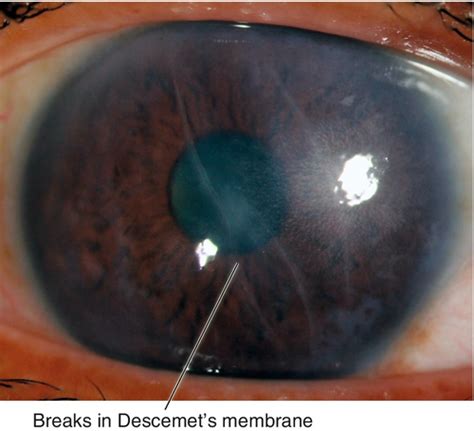 Cornea Clinical Gate