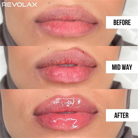 Revolax Before And Afters Examining Patients Results Fox Pharma