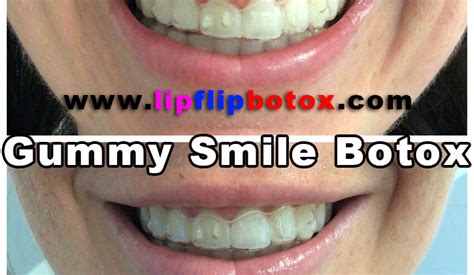 Gummy Smile Botox - Lip Flip Botox