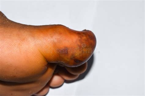 Cellulitis Big Toe Infection