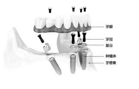 湘西口腔医院种植牙价格表含湘西单颗半口全口种牙费用种植牙 8682赴韩整形网