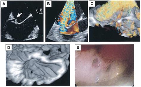 Figure 2 From Assessment Of Mitral Valve Leaflet Perforation As A