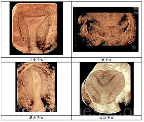 助受孕 香港中大首設慣性流產門診 中文大學 婦產科 大紀元