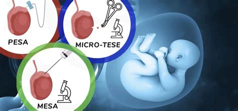 Testicular Biopsy PESA Procedure MICROTESE Procedure MESA Procedure