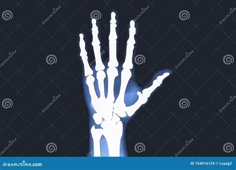 X-rayed Human Hand. X-ray of Hand Bones. Stock Photo - Image of heal ...