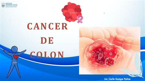 Cáncer de Colon Anac cristina Pizarro soto uDocz