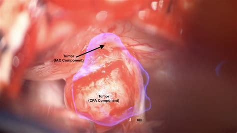 Mount Sinai Otolaryngology Surgical Series Acoustic Neuroma Vestibular