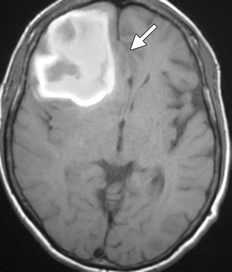 Intracranial Lesions With High Signal Intensity On T Weighted Mr