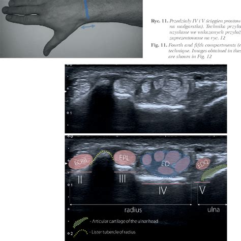 Figure 4 From Wrist Ultrasound Examination Scanning Technique And Ultrasound Anatomy Part 1