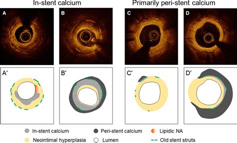 Prevalence And Impact Of Neoatherosclerosis On Clinical Outcomes After