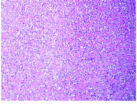 Typical Histomorphology Of Sef The Tumor Is Composed Of Epithelioid