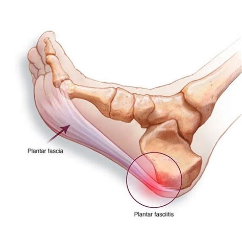 Plantar Fasciitis | Heel That Foot Pain | Motion Myotherapy Northcote ...