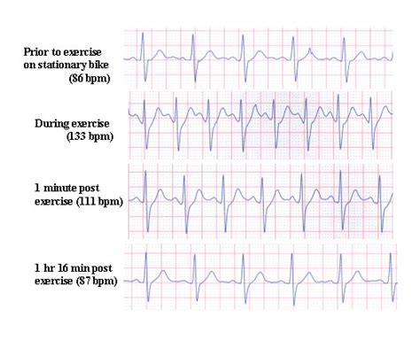 1 Lead To 12 Lead And Exercise ECG