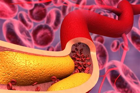 Colesterol Alto Causas Síntomas Y Tratamiento