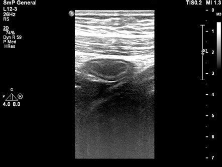 Ulcerative Colitis Radiology Case Radiopaedia Org