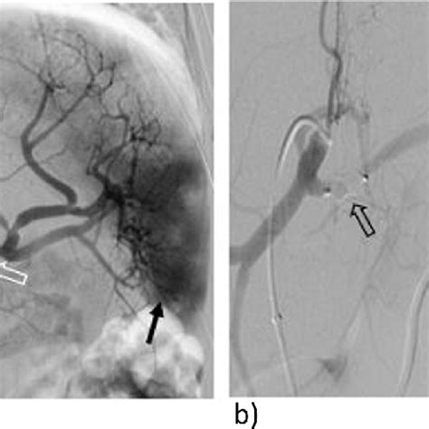 Embolization Technique A Digital Subtraction Angiography DSA Of The