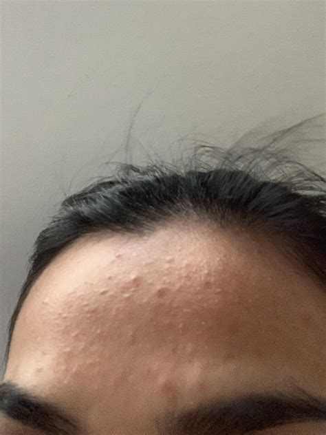 Using Curology For 10months And Bumps On Forehead Suddenly Appeared Please Help R Skincareaddicts