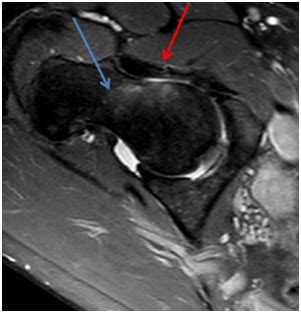 Iliofemoral Ligament Mri