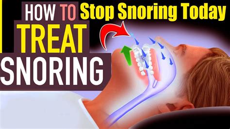 Stop Snoring Today My Sister Did This Doctors Are Shocked How To