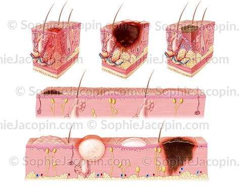 Pathologies Peau Illustration Medicale Sophie Jacopin