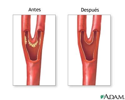 MedlinePlus Enciclopedia Médica Cirugía de la arteria carótida Serie