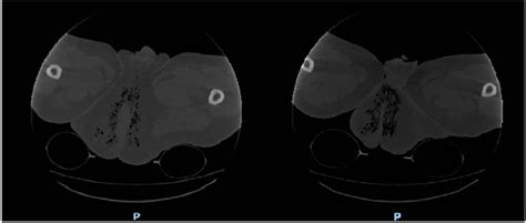 Figure 1 From Fourniers Gangrene As A Rare Complication In Patient