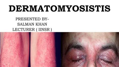 DERMATOMYOSITIS.pptx