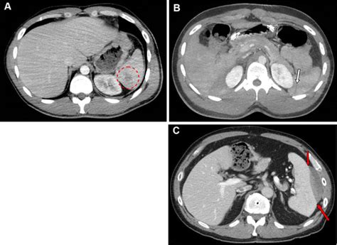 Grading Abdominal Trauma Changes In And Implications Of The Revised