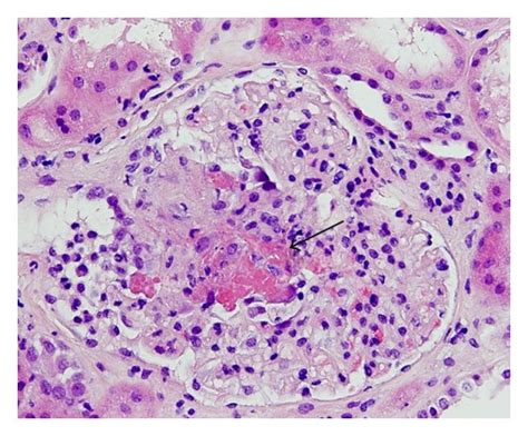 Kidney Biopsy A Glomerulus Showing Cellular Crescent Arrow With