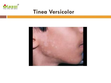 Ppt Tinea Versicolor Symptoms Causes Diagnosis And Treatment Powerpoint Presentation Id