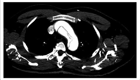 CT angiography showed aortic dissection involving the aortic arch ...