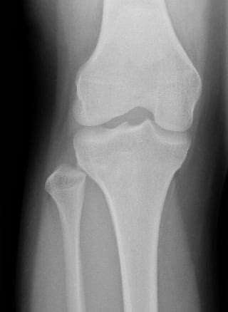 Lateral Knee Pain and the Proximal Tibiofibular Joint