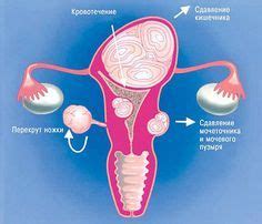 Миома матки | Лечение, Здоровье и красота